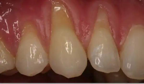 Image for case Multiple gingival recessions treated with the modified coronally advanced flap in conjunction with mucoderm®