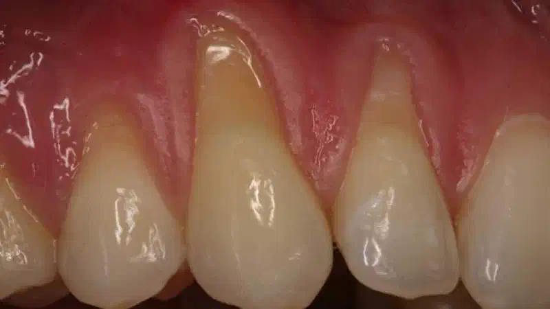 Multiple gingival recessions treated with the modified coronally advanced flap in conjunction with mucoderm®