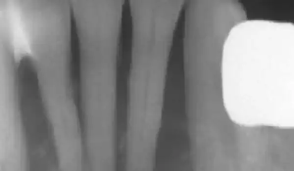 Image for case Soft tissue augmentation and GBR with mucoderm® and maxresorb®