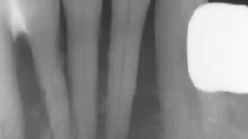 Soft tissue augmentation and GBR with mucoderm® and maxresorb®