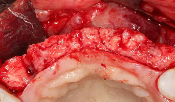 Image for case Ridge splitting and gingival contour augmentation with mucoderm®
