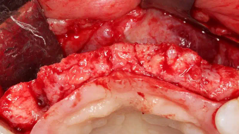 Ridge splitting and gingival contour augmentation with mucoderm®