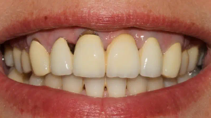 Soft tissue augmentation with mucoderm® for pontic