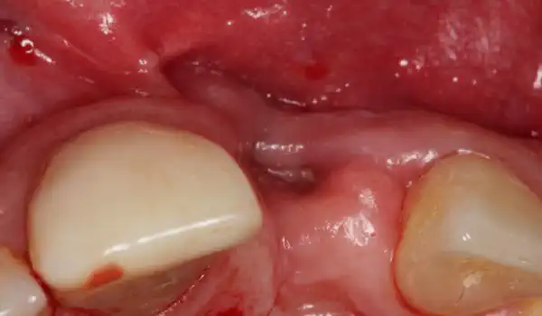 Image for case Augmentation of a traumatic soft tissue defect with mucoderm®