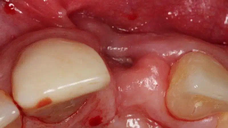 Augmentation of a traumatic soft tissue defect with mucoderm®