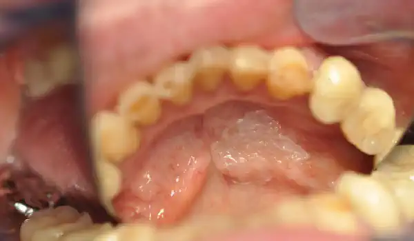 Image for case mucoderm® for soft tissue augmentation after resective surgery