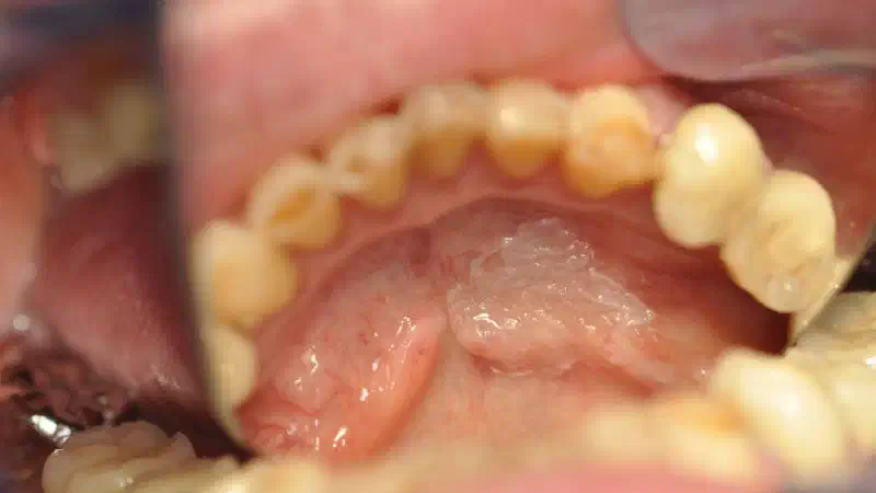 mucoderm® for soft tissue augmentation after resective surgery