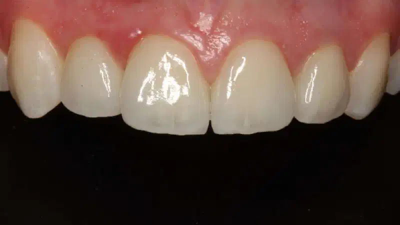 Soft tissue thickening at immediate implant placement and GBR with mucoderm® and maxgraft®