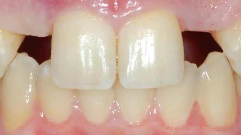 Soft tissue augmentation around missing lateral incisors with mucoderm®