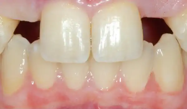 Image for case Soft tissue augmentation around missing lateral incisors with mucoderm®