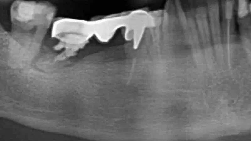 Peri-implant soft tissue augmentation for pontic with mucoderm®