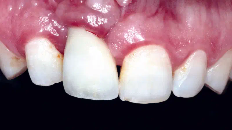 Treatment of a failed implant in the aesthetic zone