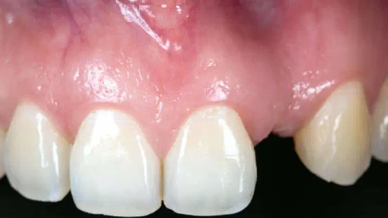 Horizontal ridge augmentation using cerabone® block, permamem® and Jason® membrane