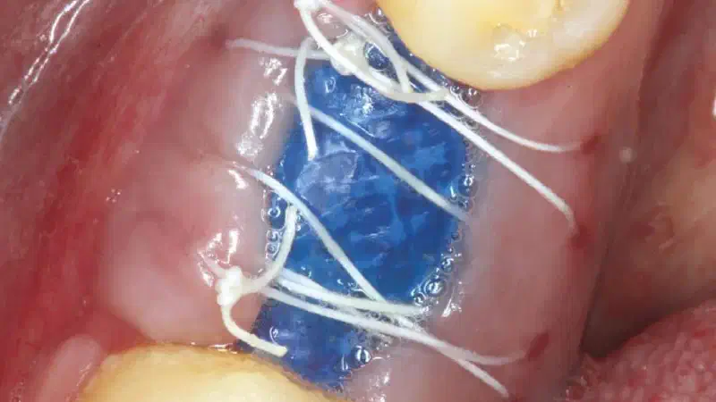 Covering of an immediately placed implant with permamem®