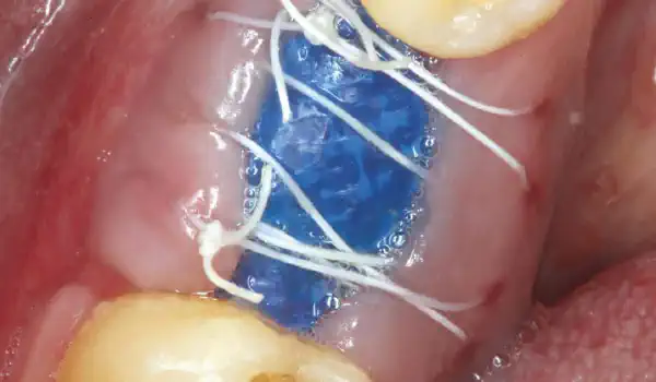 Image for case Covering of an immediately placed implant with permamem®