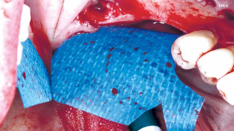 Horizontal GBR using maxgraft® and permamem®