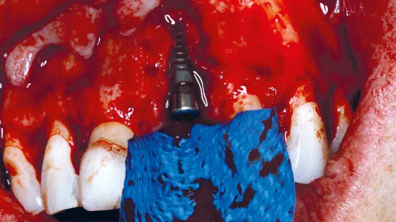 Implant placement and bone augmentation in the aesthetic zone using maxgraft® and permamem®
