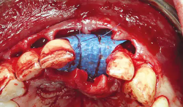 Image for case Ridge preservation with permamem®, maxgraft® granules and autologous bone – Dr. E. Valdimarsson