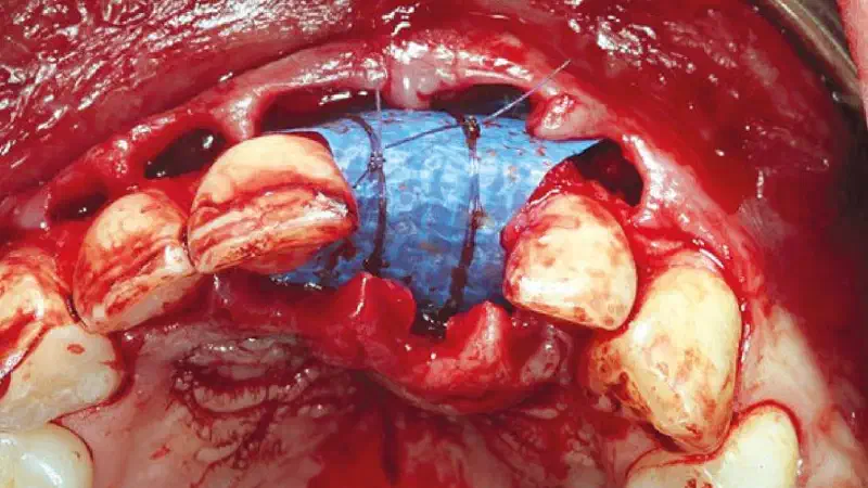 Ridge preservation with permamem®, maxgraft® granules and autologous bone – Dr. E. Valdimarsson
