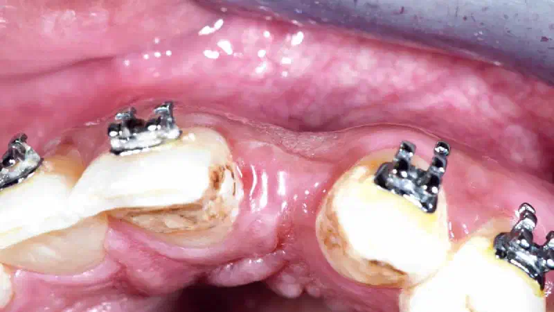 Bone defect augmentation in the aesthetic zone using cerabone® and permamem®
