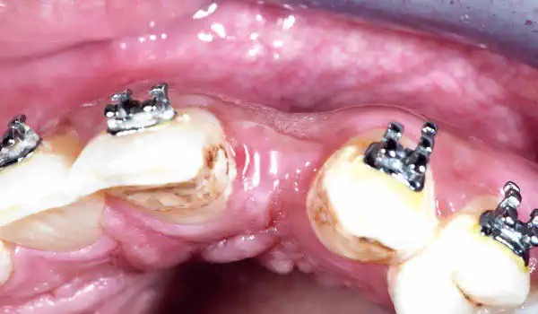 Image for case Bone defect augmentation in the aesthetic zone using cerabone® and permamem®