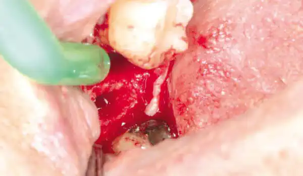 Image for case Socket preservation using cerabone®, Jason® membrane and permamem®