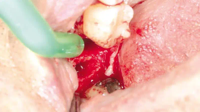 Socket preservation using cerabone®, Jason® membrane and permamem®