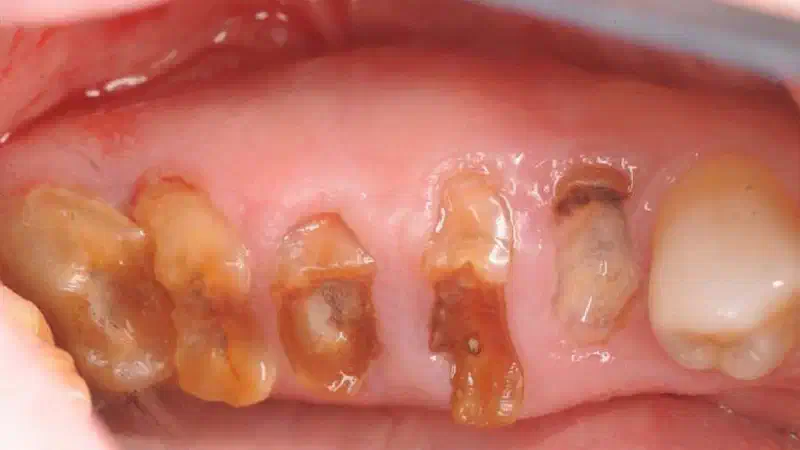 Multiple socket preservation using permamem® and collacone® max