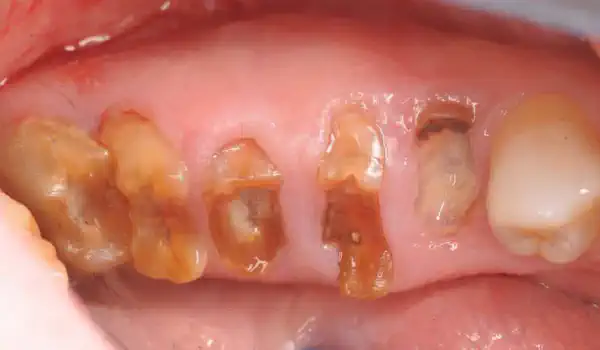 Image for case Multiple socket preservation using permamem® and collacone® max