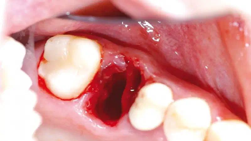 Socket preservation with permamem®