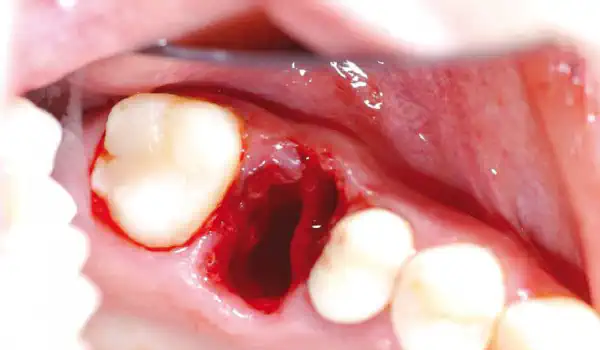 Image for case Socket preservation with permamem®