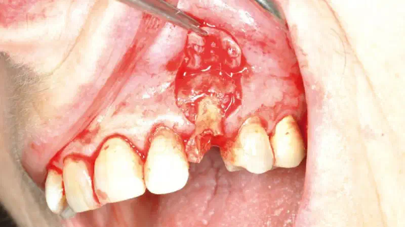 Ridge preservation and reconstruction of the buccal wall using permamem® and cerabone®