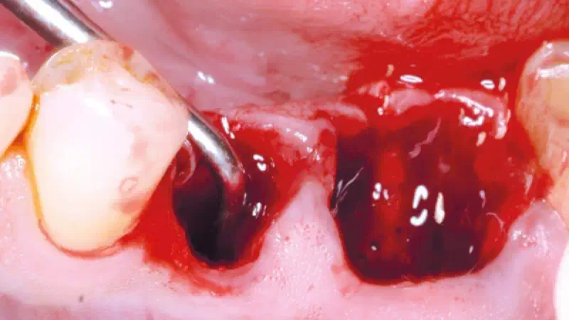 Sealing of two postextraction sites with permamem®