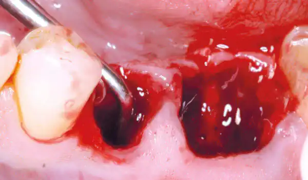 Image for case Sealing of two postextraction sites with permamem®