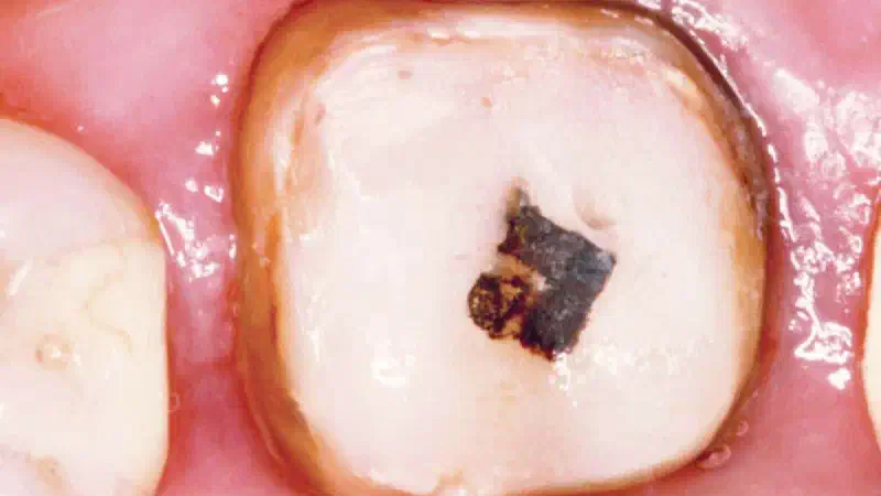 Socket preservation using permamem®