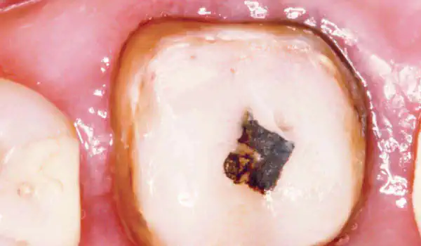 Image for case Socket preservation using permamem®