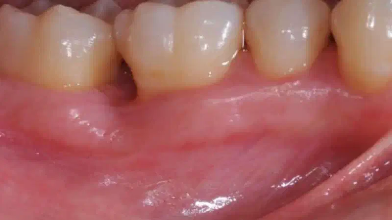 Deep intrabony defects treated using Straumann® Emdogain®