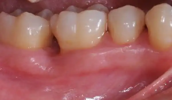 Image for case Deep intrabony defects treated using Straumann® Emdogain®