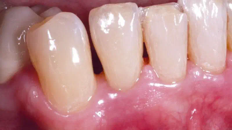 Non-contained intrabony defect treated using Straumann® Emdogain® and a synthetic bone grafting material
