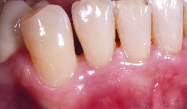 Image for case Non-contained intrabony defect treated using Straumann® Emdogain® and a synthetic bone grafting material