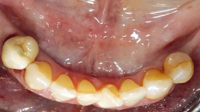 Augmentation of an atrophic ridge with maxgraft® bonebuilder