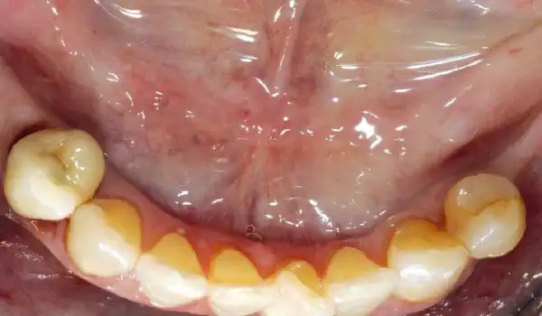 Image for case Augmentation of an atrophic ridge with maxgraft® bonebuilder