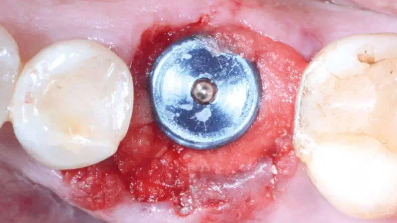 Immediate implant placement in the mandibular with collacone® max