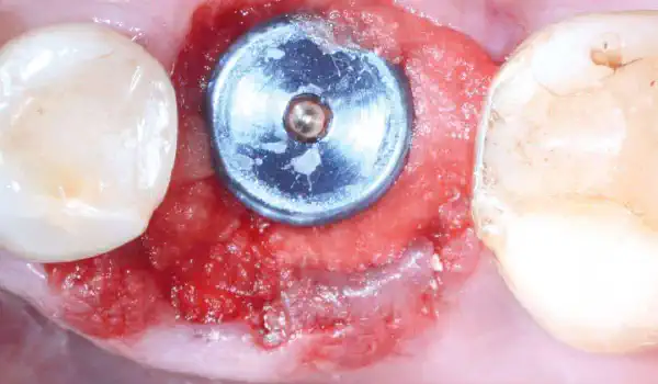 Image for case Immediate implant placement in the mandibular with collacone® max