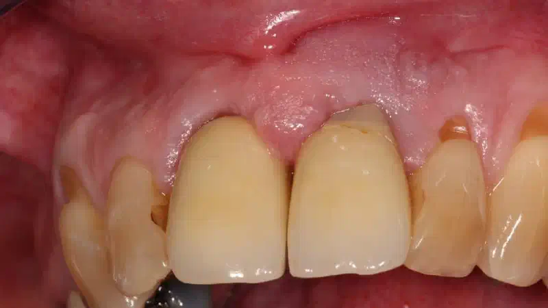 Bone augmentation in the aesthetic zone with maxgraft® bonering
