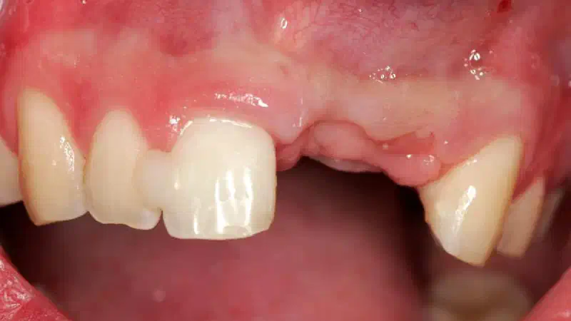 Bone augmentation in the aesthetic zone with maxgraft® bonering and L-PRF™