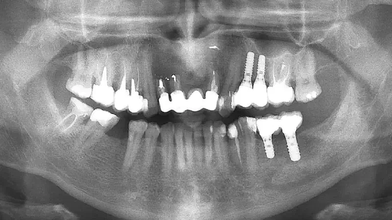 Long-term case: socket preservation and bone augmentation with two maxgraft® bonerings