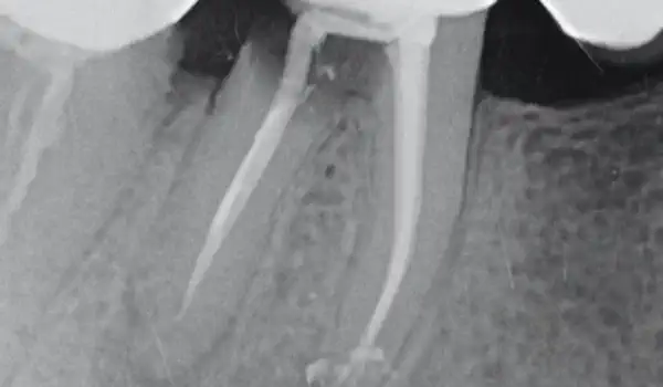 Image for case Immediate implantation with maxresorb®