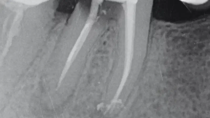 Immediate implantation with maxresorb®