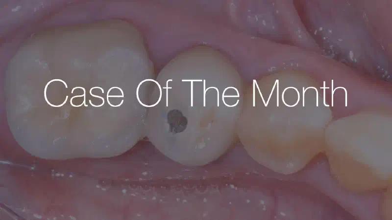 Socket Preservation with maxresorb® and mucoderm®